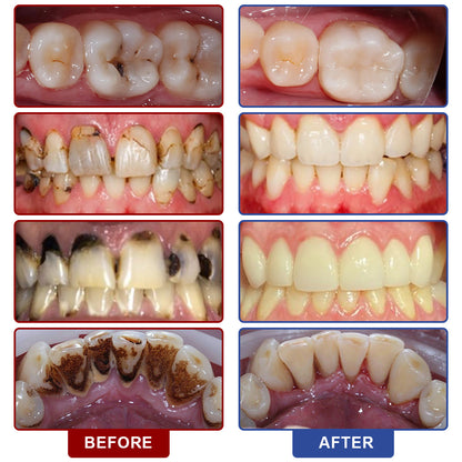 🆙🦷Oral Care Liquid– Effectively treats enamel damage, gum inflammation, toothaches, sensitive teeth, gum bleeding, periodontitis, cavities, mouth ulcers, and bad breath.